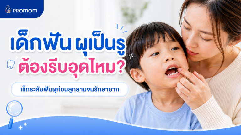 เด็กฟันผุเป็นรู ต้องรีบอุดไหม? เช็กระดับฟันผุก่อนลุกลามจนรักษายาก